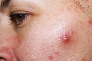 Phương pháp điều trị mụn bọc tốt nhất