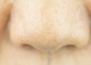 Điều trị mụn cám tận gốc