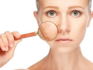 Điều trị nám nông bằng công nghệ - laser fractional co2