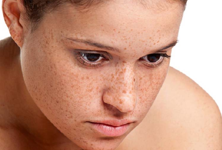 Điều trị nám sâu hiệu quả tối ưu