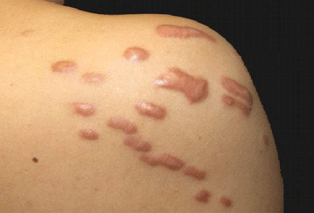 Điều trị sẹo lồi hiệu quả