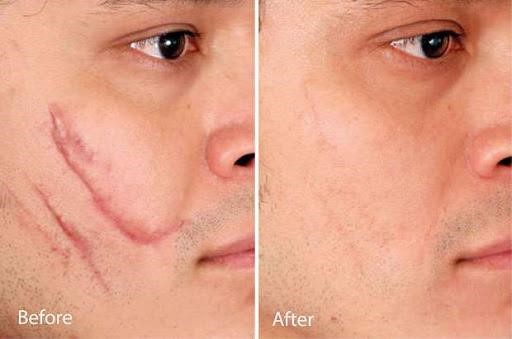 Tiêm sẹo lồi – khắc phục sẹo lồi trên da nhanh chóng