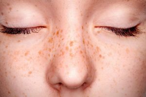 Điều trị tàn nhang có hết 100% không?