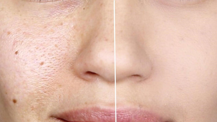 Công nghệ Picosecond Laser – đánh bay tận gốc vết tàn nhang
