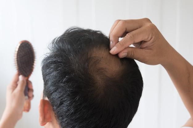 Trị hói đầu hiệu quả chỉ sau 1 liệu trình