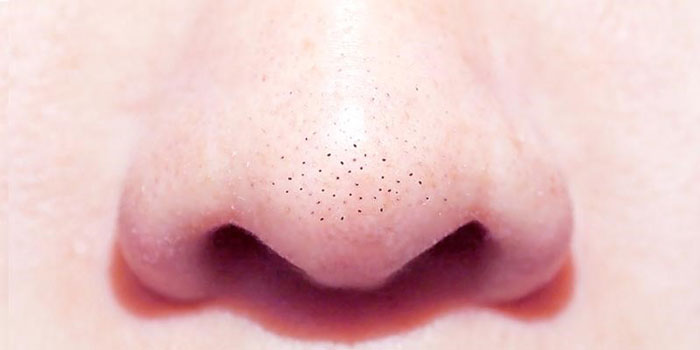 Trị mụn đầu đen triệt để với Long Pulse Laser