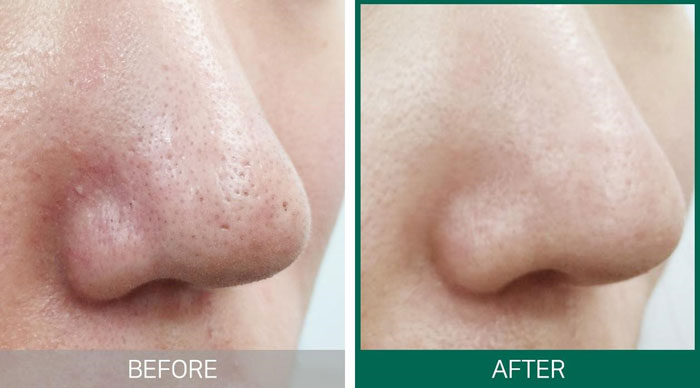 Trị mụn đầu đen - xóa sạch triệt để