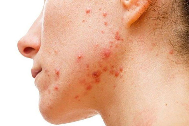 Trị trứng cá nhanh chóng hiệu quả
