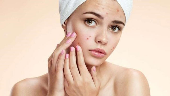 Nguyên nhân của mụn trứng cá