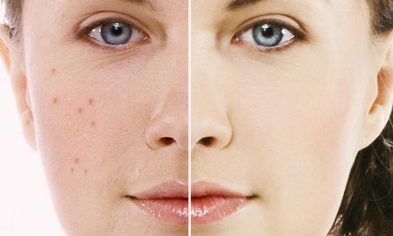 Các phương pháp điều trị mụn trứng cá