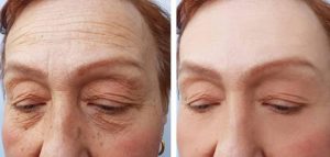 Kết quả điều trị xóa nhăn trán còn tùy thuộc vào cơ địa khách hàng