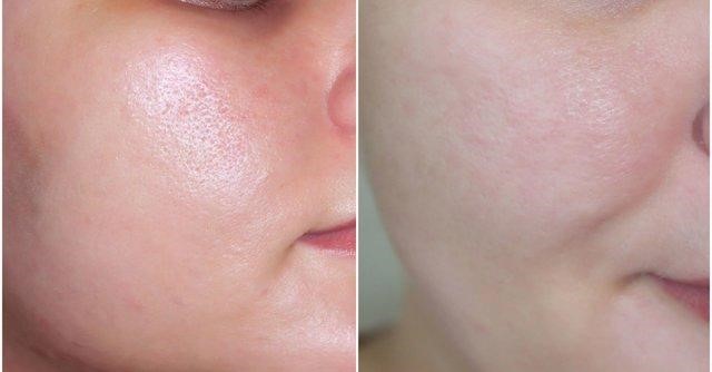 Kết quả rõ rệt ngay sau liệu trình điều trị đầu tiên