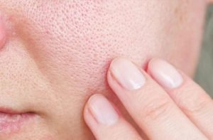 Lỗ chân lông to khiến làn da không được mịn màng