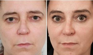 Nâng cung mày – “hồi xuân” với nét trẻ đẹp rạng ngời