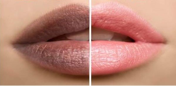 Phương pháp xóa thâm môi, nách các chị em phải biết
