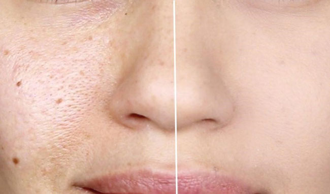 Se khít lỗ chân lông bằng Long Pulse Laser hiệu quả vượt mong đợi