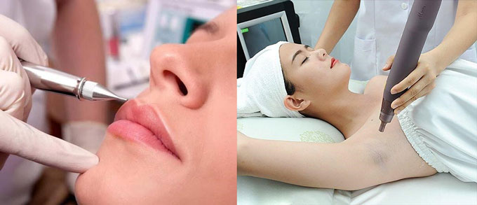 Xóa thâm môi, nách bằng công nghệ Piso Second Laser