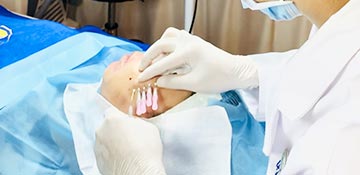 Căng da mặt bằng chỉ