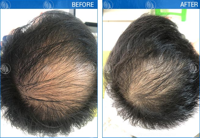 Ảnh before after điều trị rụng tóc 2