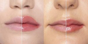 Phương pháp làm đầy môi, má hóp an toàn nhất hiện nay