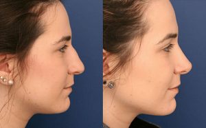 Giải pháp nâng mũi, độn cằm không cần phẫu thuật