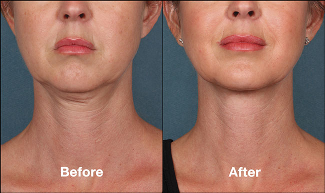 Cách xóa cằm đôi không cần phẫu thuật?