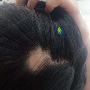 Bệnh nhân bị rụng tóc miễn dịch