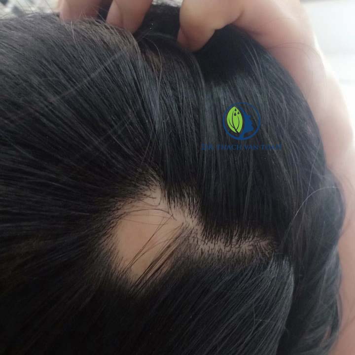 Bệnh nhân bị rụng tóc miễn dịch