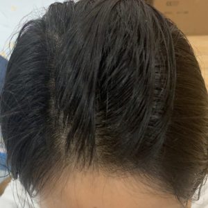 Tóc bết, Da đầu nhiều dầu nhờn