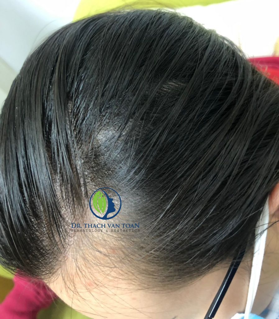 BN có Tóc Nhiều Dầu Nhờn, Tóc Bết